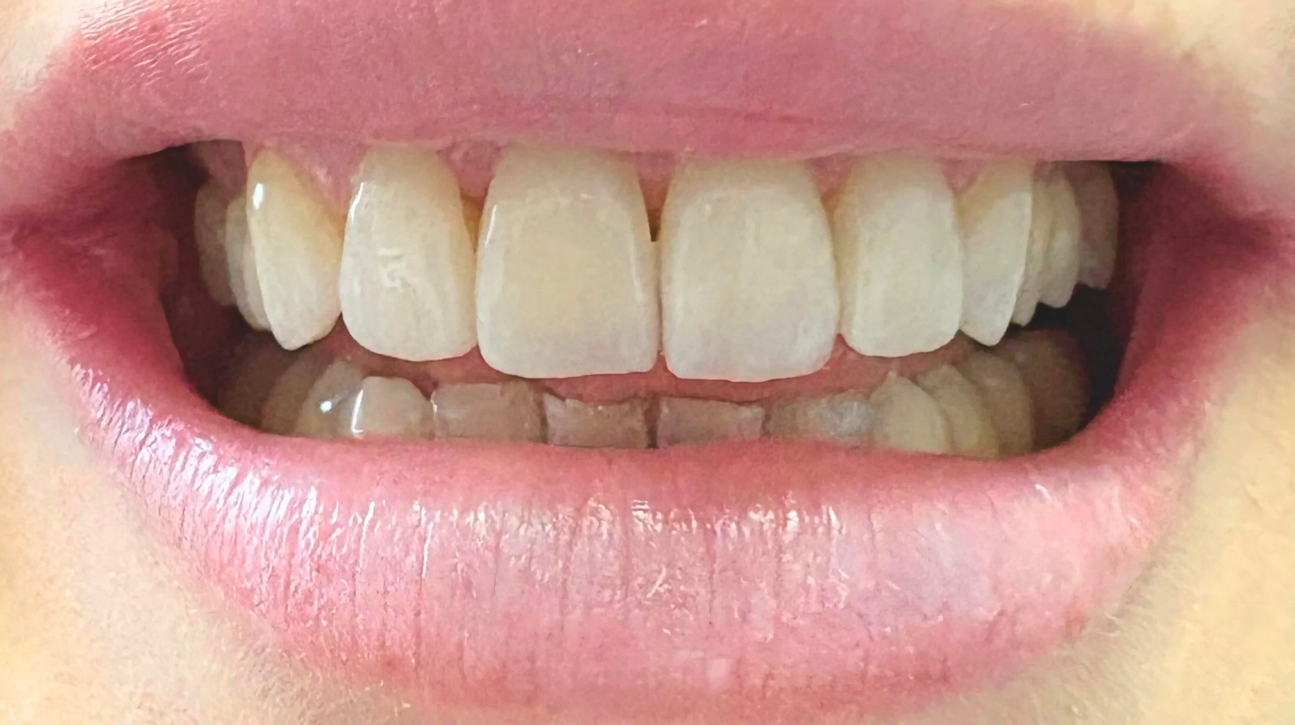 Faccette-dentali1_dopo-scaled-1