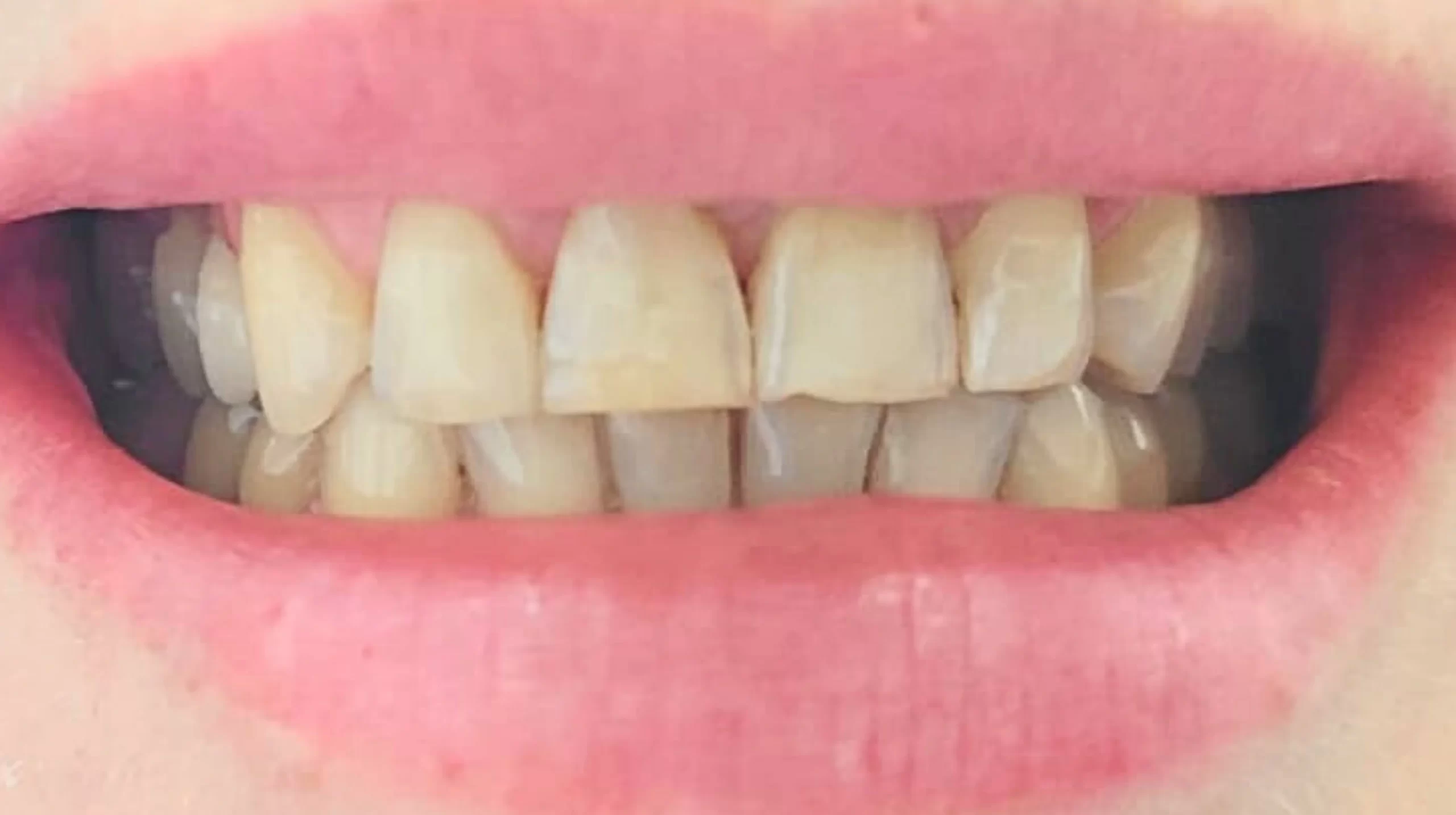 Faccette-dentali1_prima-scaled-1